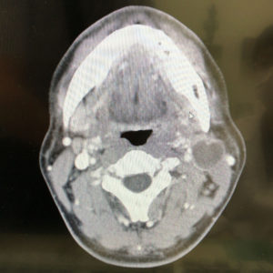 CT。向かって右、中程に腫脹がある。（画像は担当医の許可を得て撮影）。