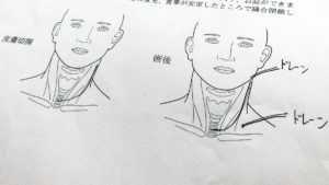 切開箇所。説明文書より。ドレーンについては後述。