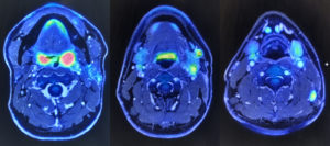 PET-MRIの画像。担当医の許可を得て撮影。赤や黄色で反応しているのが分かる。（通常の箇所も多少は光るものだとか）